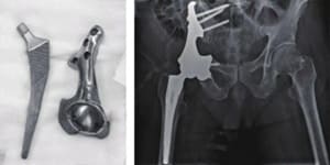 Tantalum pelvis and hip joints