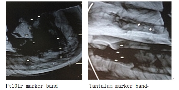 Radiopacity Comparison: Tantalum vs. Platinum-Iridium Marker Bands